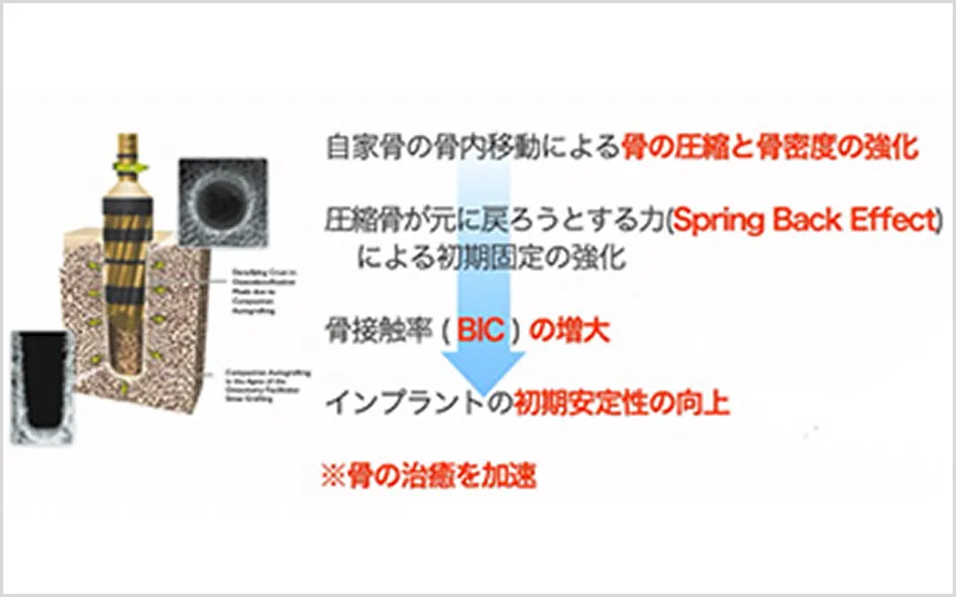 自家骨の骨内移動による骨の圧縮と骨密度の強化。圧縮骨が元に戻ろうとする力による初期固定の強化。骨接触率の増大。インプラントの初期安定性の向上。※骨の治癒を加速