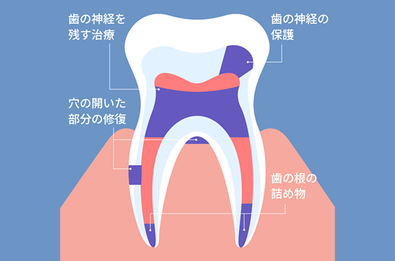 神経保存のための治療を行った歯の内部のイラスト
